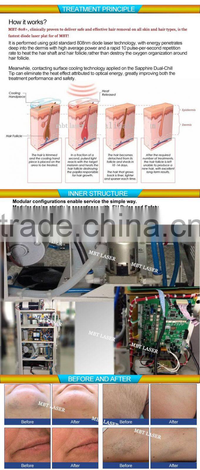 Freezing permanent hair removal diode laser 810 diode laser hair removal