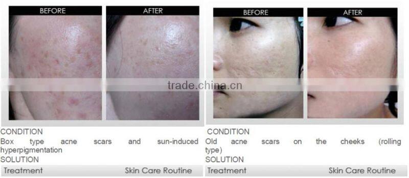 540 derma roller