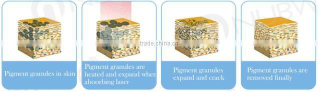 Professional best cooling system q switch nd:yag tattoo removal laser machine with good result