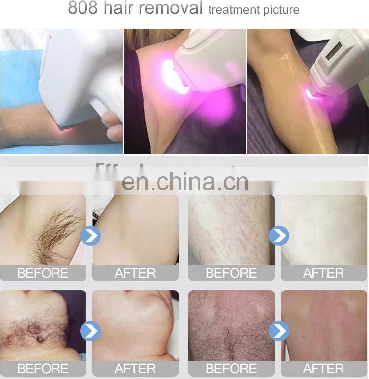 1000W Laser Bar 808 nm Hair Removal 100w 808nm Laser Diode Bar Array Diodo 808 Laser bar