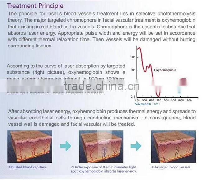 RBS03- Ramya Professional diode 980nm laser spider vein removal (CE )
