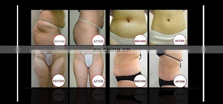 Cryolipolysis Machine For Home Use, Cryolipolyse Machine Portable