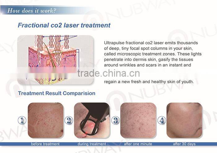 American tube rf drive co2 laser stretch mark removal machine for salon