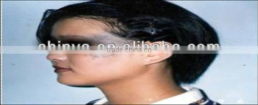 1064nm&532nm Q-switch Nd:YAG laser machine