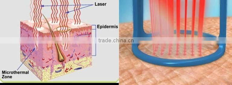 co2 fractional laser machine
