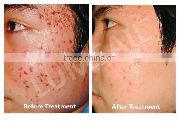 2014 New Arrival pdt led for whitening skin rejuvenation