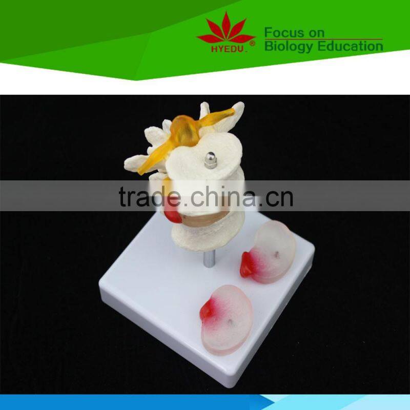 High quality for medical educational supply 2 lumbar vertebrae skeleton model with hernia and prolapsed intervertebral disc