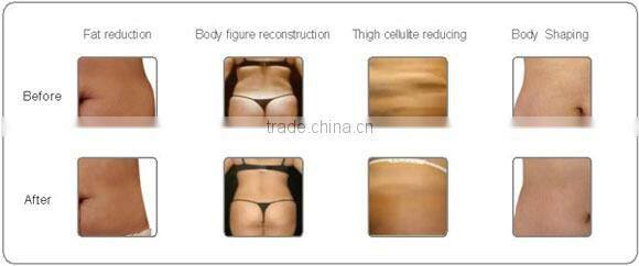 T&B supplier radio frequency ultrasonic cavitation rf machine CE