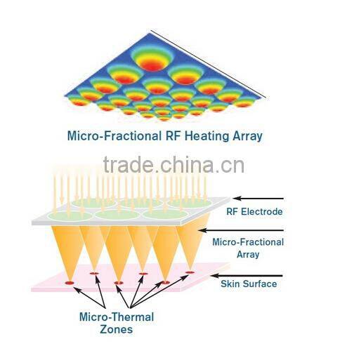 5Mhz Bipolar facial skin tightening devices