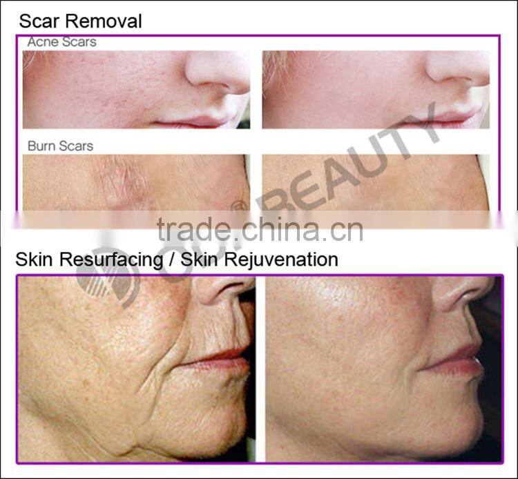 World best selling fractional co2 stretchmark and scar removal laser machine