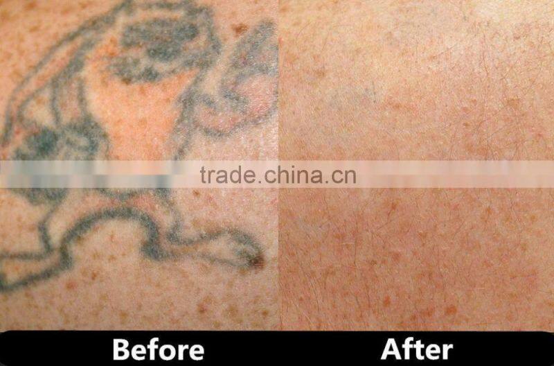 CE Certification Q Switch ND YAG laser machine for tattoo pigmentation removal