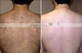 Portable Intense Pulsed Light IPL Acne/Hair Removal Device