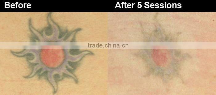 Professional Q-switch ND YAG Laser