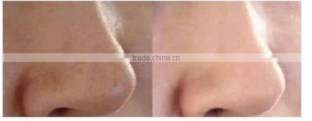 Portable Small Gas Bubble Facial Cleaning