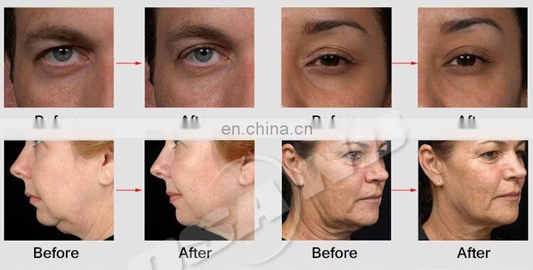 OSANO Best Vela Body Contouring Equipment LM-S500F CE RF Vacuum Velasahpe Beauty Slimming Equipment