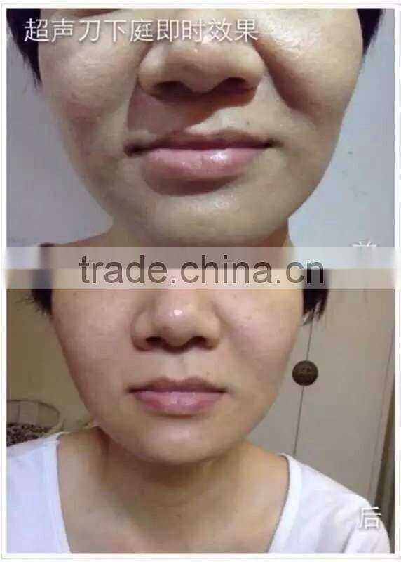 Home use Ultra lift HIFU korea