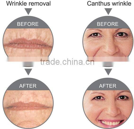 3 IN I Laser Tattoo Removal Machine RF Machine IPL Hair Removal Multifunctional Beauty Salon Equipment OD-IRL10