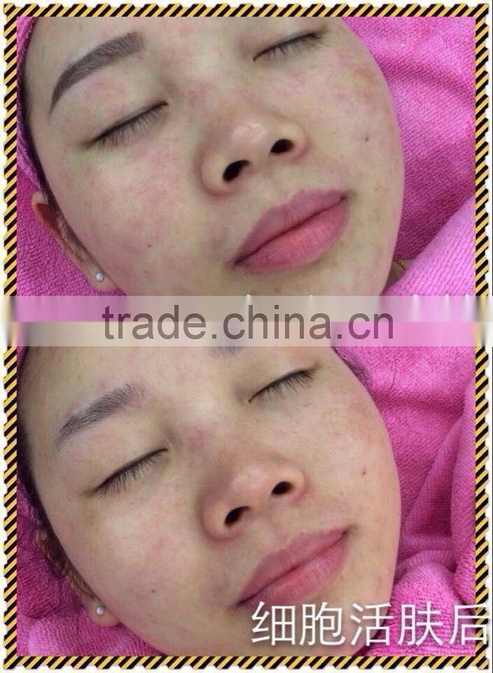 basic skin daily care water oxygen jet peel machine for salon private beauty center