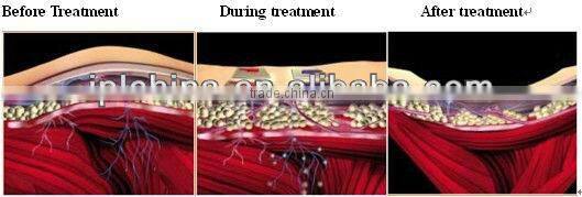 Cyclone Shape - The Best Weight Loss Cyclone rf Beauty Machine