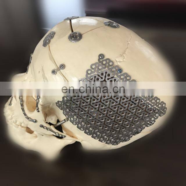 Maxillofacial Titanium Mesh Trauma Implants Mini Screw for Maxillofacial