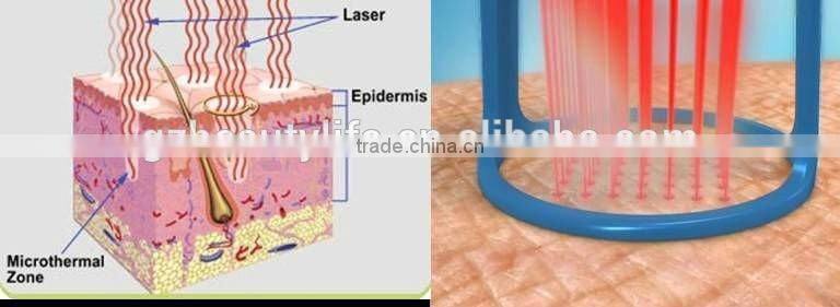 fractional co2 laser equipment