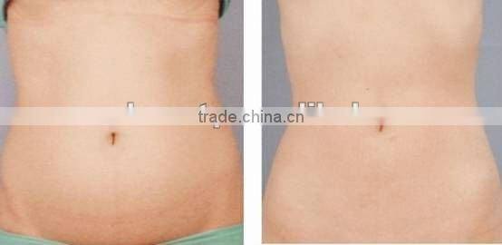 new generation! Body shaping ultrasonic liposuction equipment F017 machine