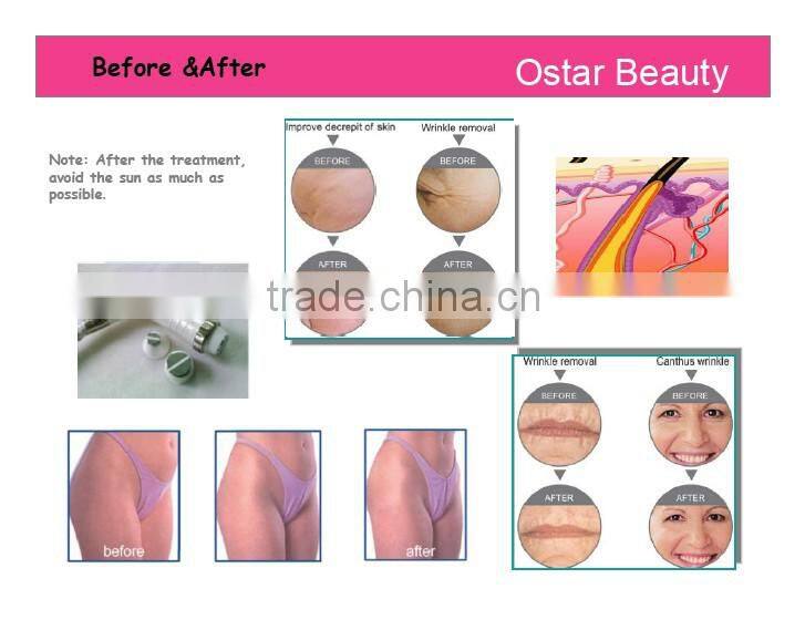 Bi-polar and Tripolar RF wrinkle remover face lifting machine RF 03