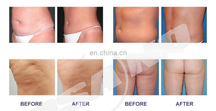 OSANO Best Vela Body Contouring Equipment LM-S500F CE RF Vacuum Velasahpe Beauty Slimming Equipment