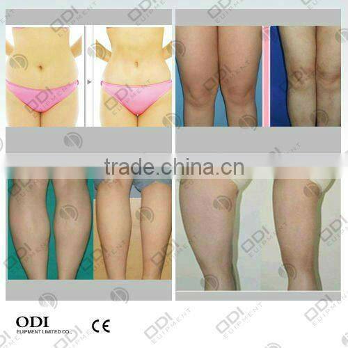 (CE approved)2014 Best Selling Body Vacuum Suction Machine For SALE!(OD-S60)