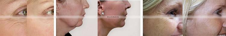 non surgical face and neck rf microcurrent face lift machine