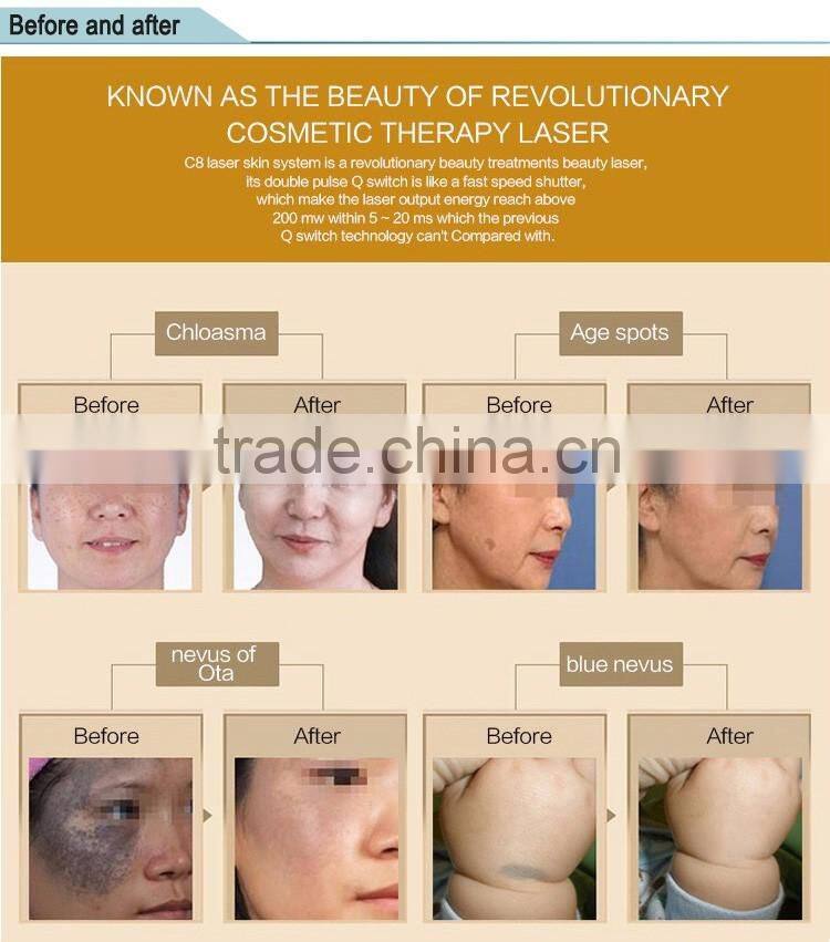 q-switch nd yag laser advanced import&export surgical product / skin tightening machine