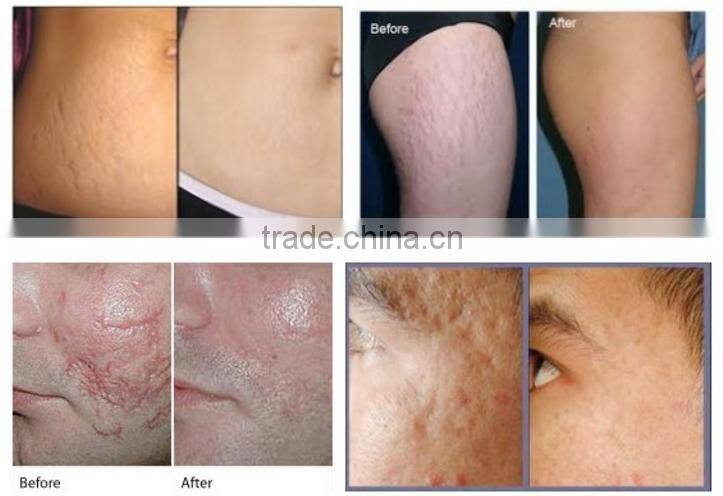 JMSHR Salon/Hospital Use 30W Korea Import Arm CO2 Fractional Laser RF Tube For Eyebrow Lid Removal