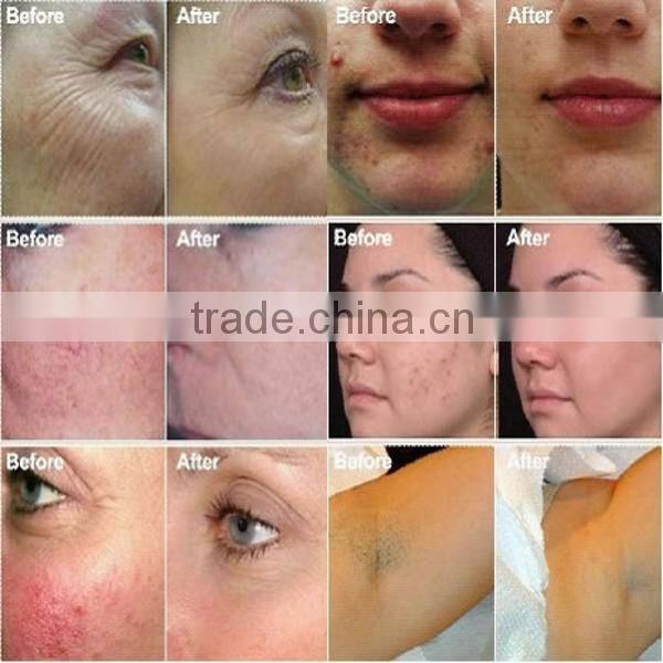 Multifunction 4 in 1 hair removal ipl elight nd yag laser aesthetics