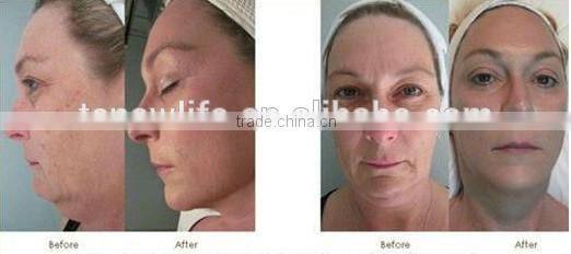 Diamond dermabrasion machine 3 in 1 microdermabrasion with crystals,diamond dermabrasion