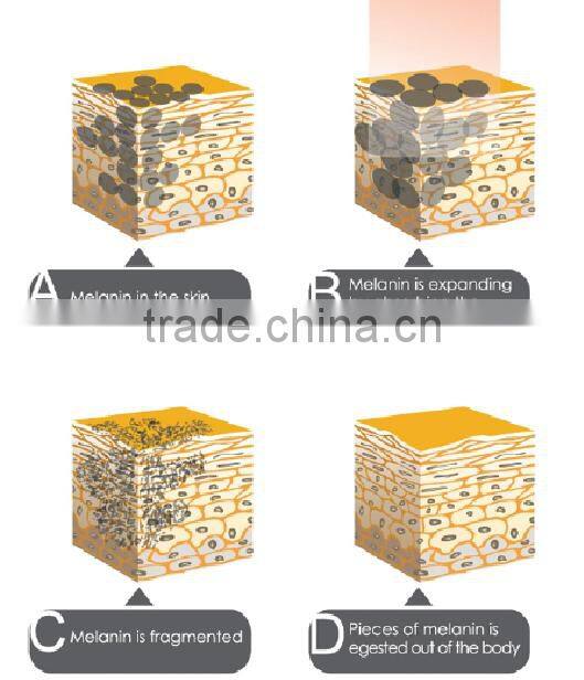 Popular tattoo removal Q Switched Nd YAG laser beauty machine