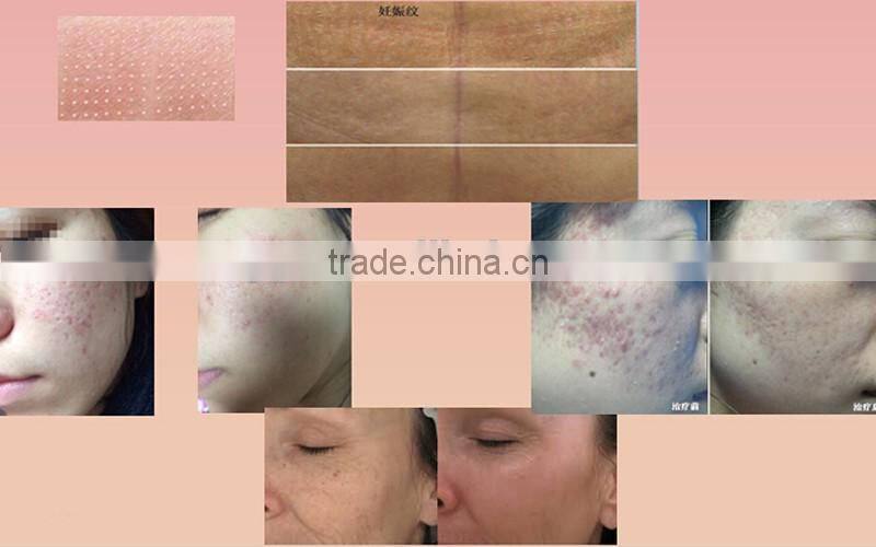 fractional CO2 laser scar removal vaginal tightening facial acne pit removal