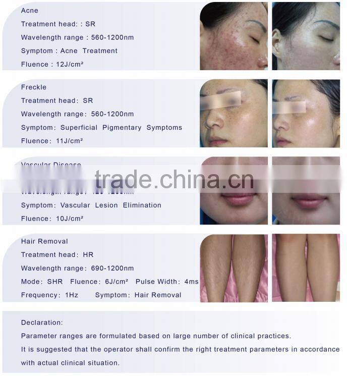 Permanent Hair Removal Intense Pulsed Light Monaliza NYC3 Laser IPL