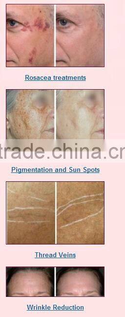 Professional Cosmetic Elight Skin Rejuvenation plus 808nm Diode Laser beauty equipment