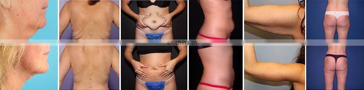 hot sale rf fast vacuum cavitation kim 8 slimming system