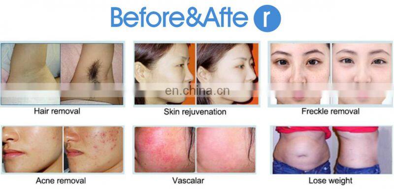 2020 most popular pigmentation removal skin tightening e-light 808nm nd yag laser multifunction machine