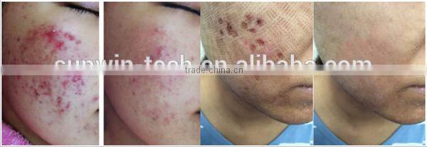 2016 hot sale laser skin renewing , skin rejuvenation, RF fractional CO2 laser dermabrasion