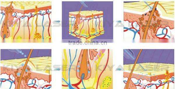 Kiyalaser manufacturer! acne treatment products