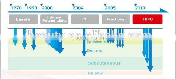 2015 Most Popular Lift Eyes&Brows Remove Crows Feet & Pouches High Intensity Focused Ultrasound Hifu