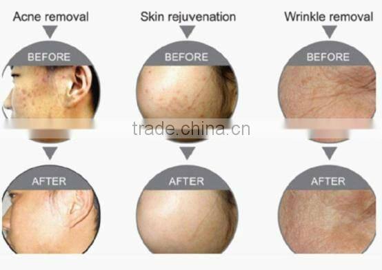 beauty salon facial machine skin moisture