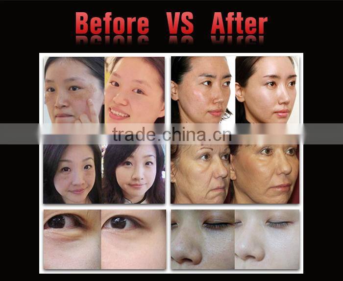 Portable salon machine / high intensity focused ultrasound for wrinkle removal / face lift 2016