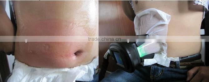 CE Approva Mini cryolipolysis fat freeze slim machine/weight loss cryolipolysis