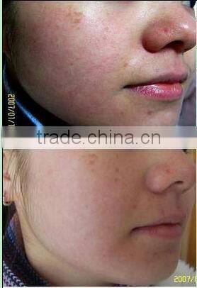 removal of lesions of the capillaries