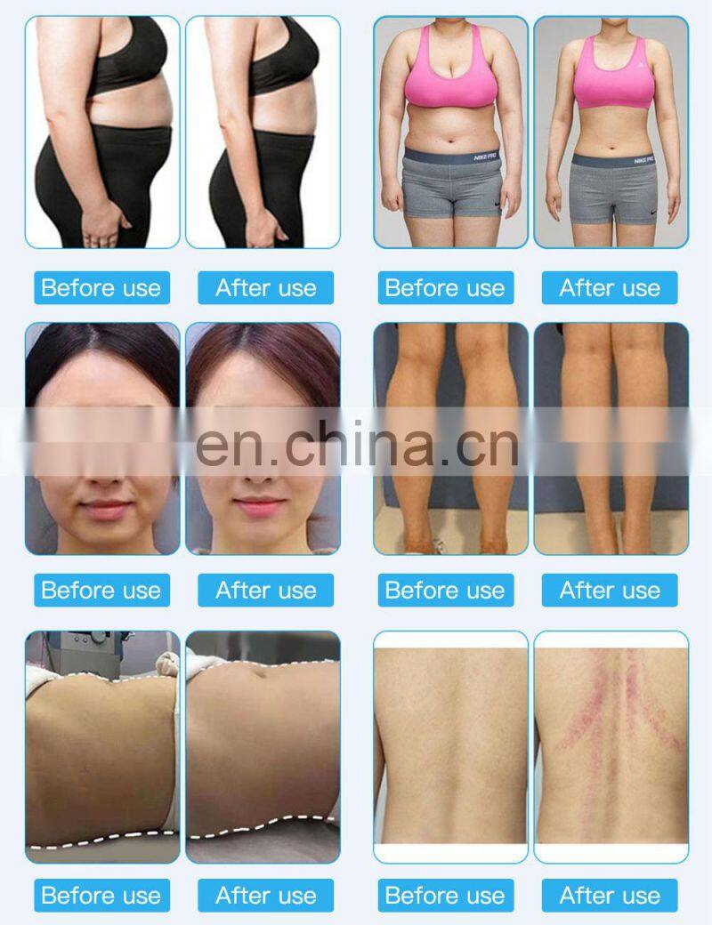 vacuum cavitation system except cryolipolysis slimming machine CAVITATION VACUUM LASTER MULTIPOLE RF Ems