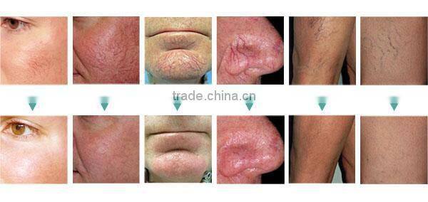 Top latest Mini Beauty Painless vascular 30Mhz spider veins laser removal machine