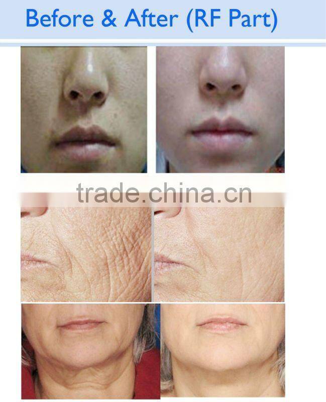 OD-IRL10A Facial equipment wholesale rf ipl multi function laser